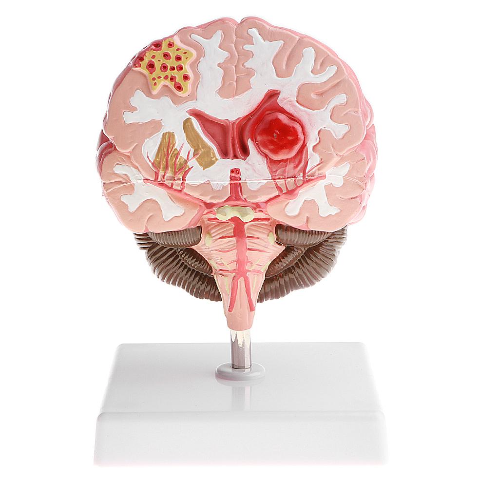 Anatomical Human Brain Disease Pathological Model Medical Teaching Tool Lab