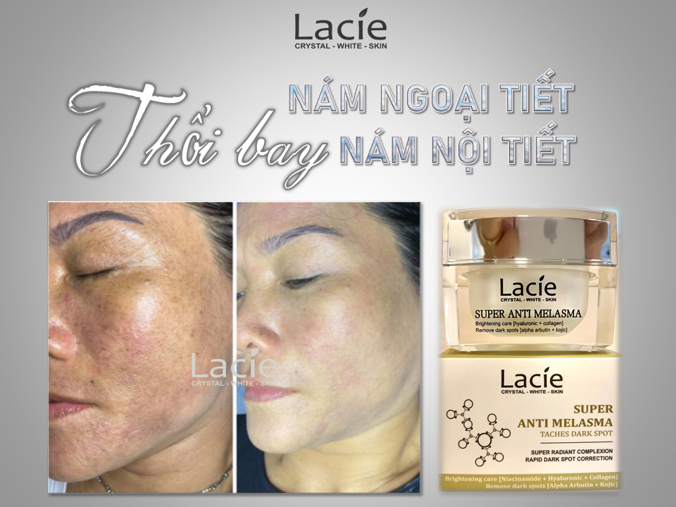 KEM NGĂN NGỪA NÁM NỘI TIẾT &amp; NGOẠI TIẾT - SUPER ANTI MELASMA