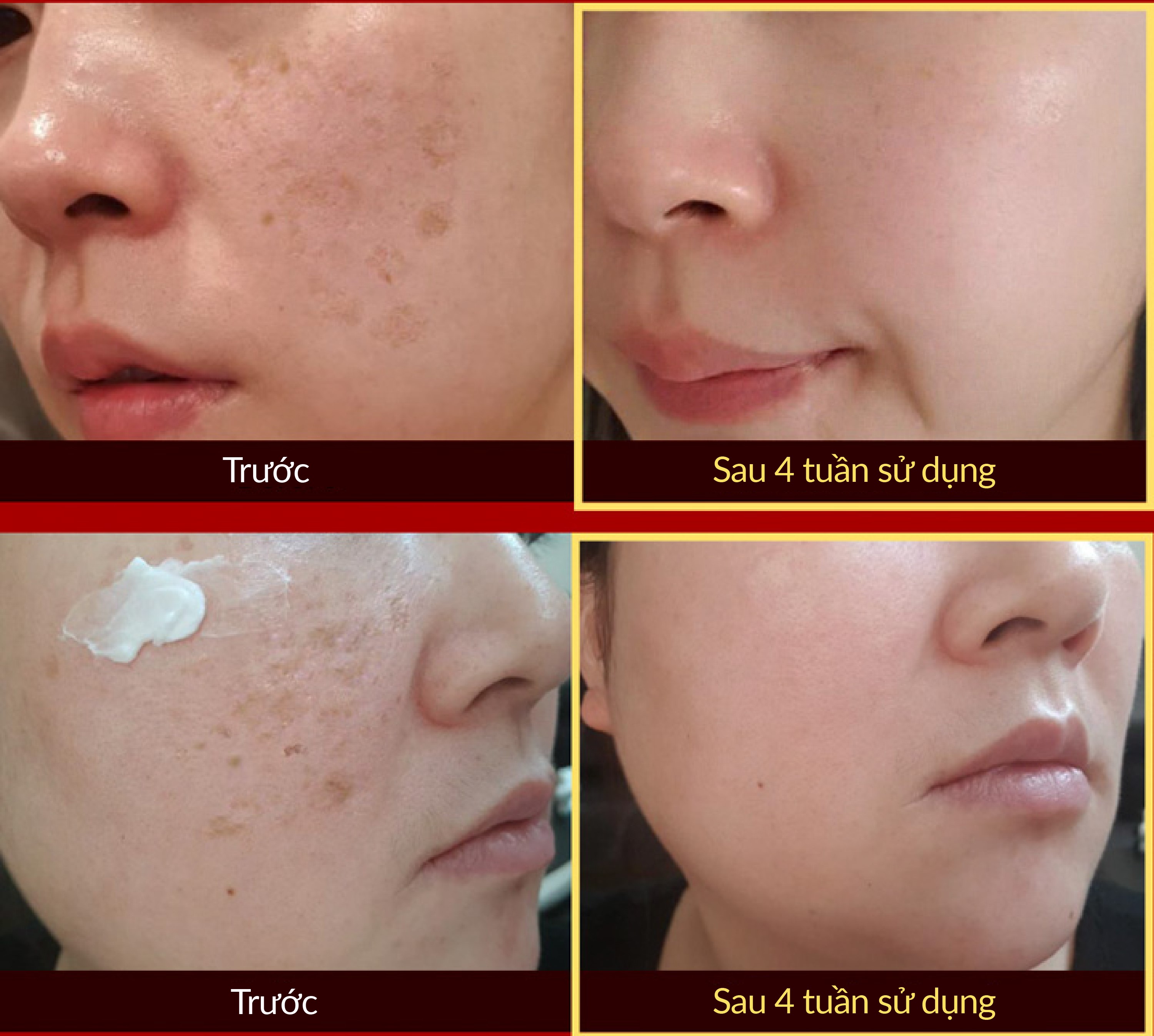 [Date 24/11/2024] Kem Mờ Nám Trắng da Hàn Quốc A.M CREAM (Anti-Melasma) 50ml {Có tem phụ nhập khẩu chính ngạch}