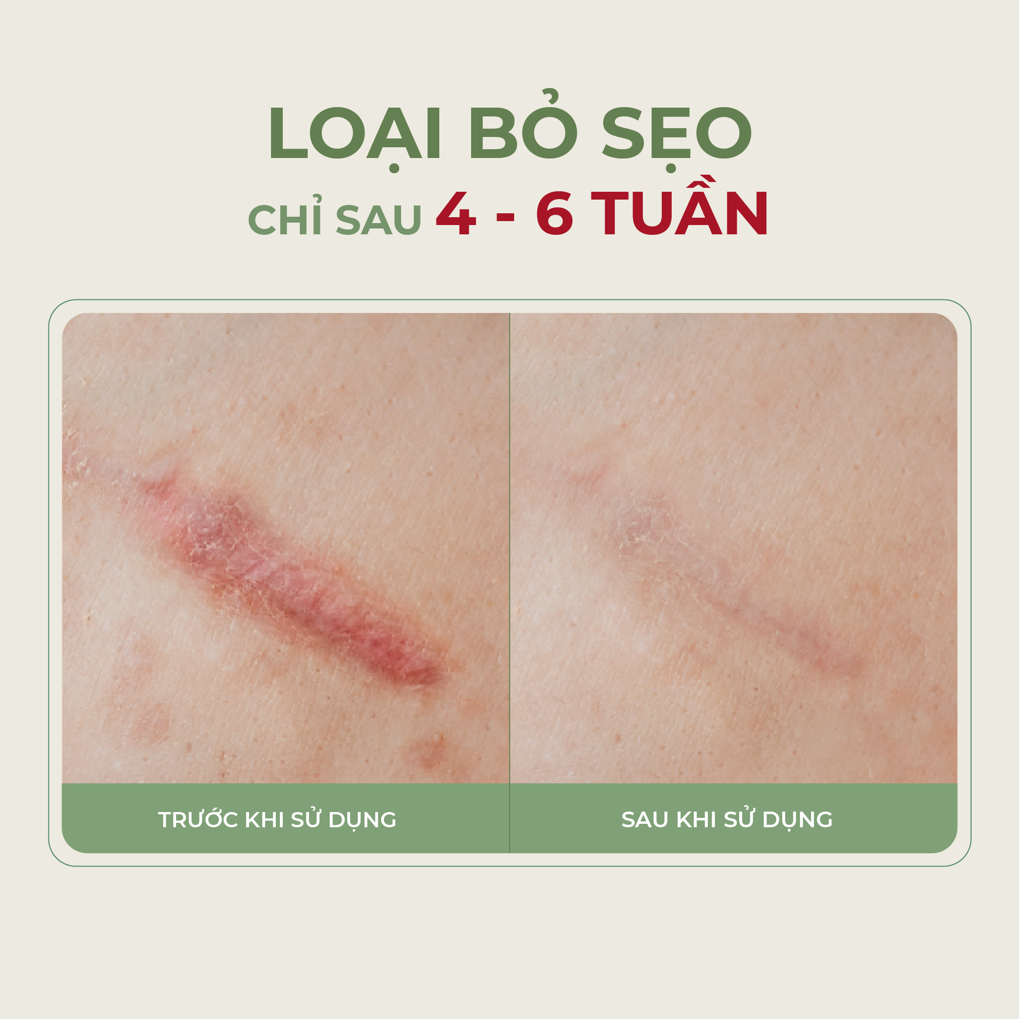 Kem Sẹo Nghệ Đỏ Abera Scar 20g Phục Hồi Làn Da Bị Sẹo An Toàn Hiệu Quả, Nhanh Chóng