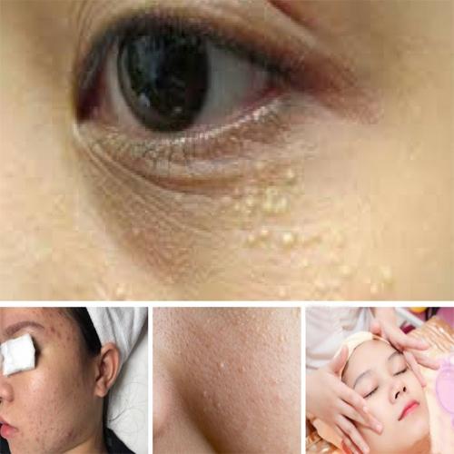 TMV SAIGON BEAUTY - ĐỐT NỐT RUỒI, MỤN THỊT AN TOÀN KHÔNG ĐỂ LẠI SẸO