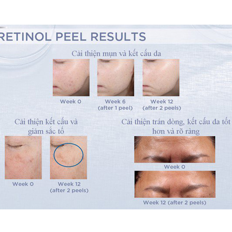 Peel da giảm nếp nhăn sạm da NeoStrata ProSystem Retinol Peel 1.5ml