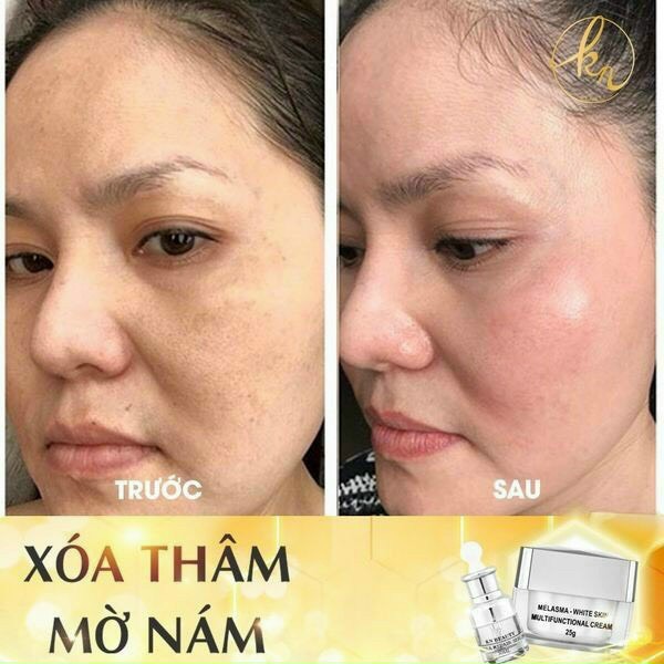 Bộ 3 sản phẩm Xóa Mờ Thâm Nám, Tàn Nhang, Đồi Mồi, Làm Trắng Da, Chống Nắng KN Beauty chuyên sâu : Kem dưỡng 25g + Serum 30ml + Sữa rửa mặt 100g