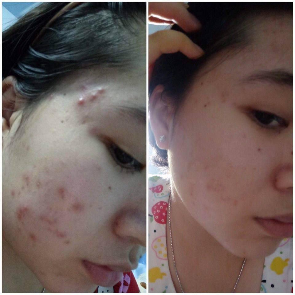 Kem mụn sưng đỏ Acne Cream IRC mụn giảm thâm, tái tạo da mới sạch khuẩn, không tái viêm 10g