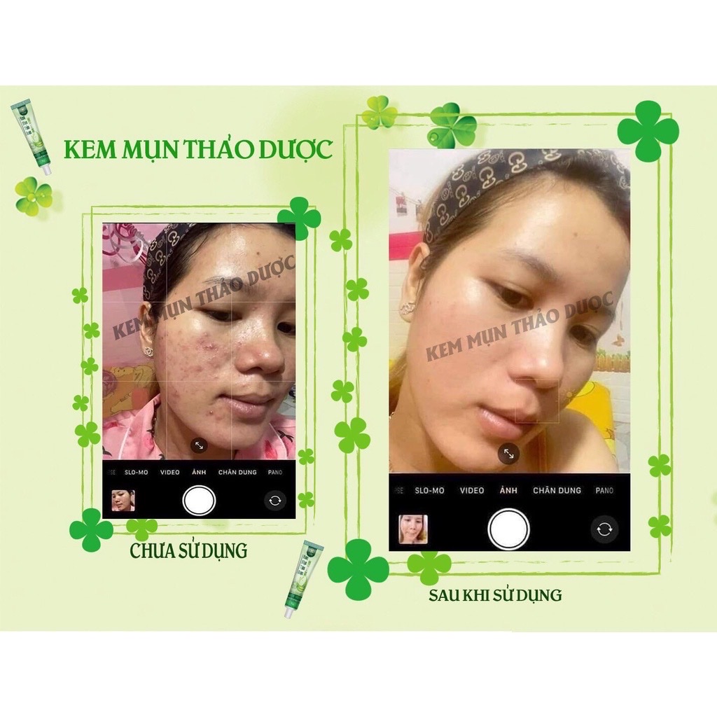 Kem Trị mụn thảo dược Sinori Giảm thâm mụn làm mờ sẹo, tẩy tế bào chết 15g