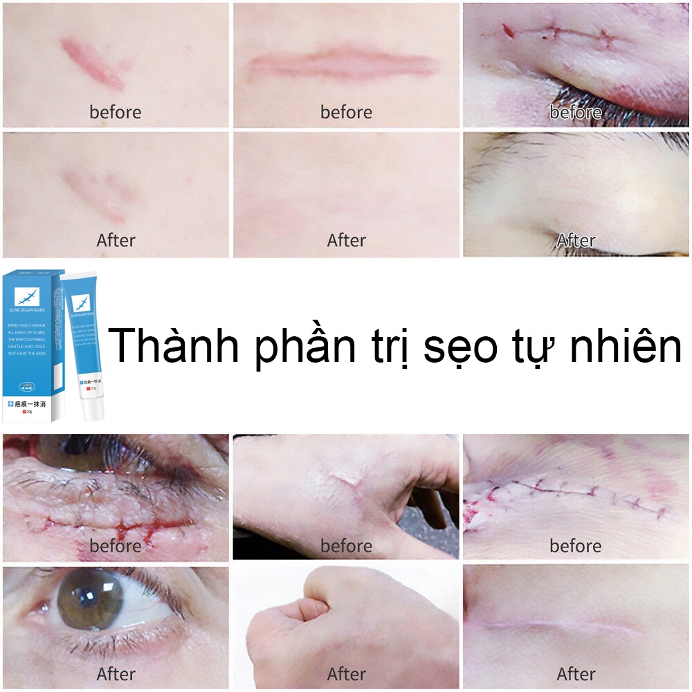 Kem trị sẹo nội địa trung/ an toàn, hiệu quả...