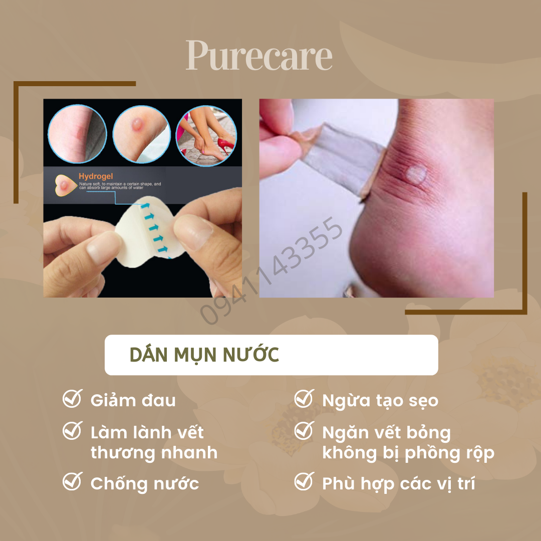 Miếng băng dán giảm mụn nước, vết chai, vết phỏng, phỏng pô, BỘ 1 CÁI