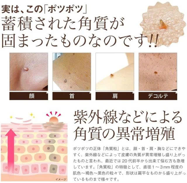 Tinh chất Ipocare EX loại bỏ vùng da sần sùi, mụn thịt, mụn cóc, 1 lọ/hộp, nhập khẩu Nhật Bản