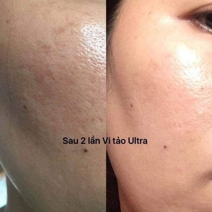 Vi Kim Tảo Biển UltraV Mẫu Mới 2021