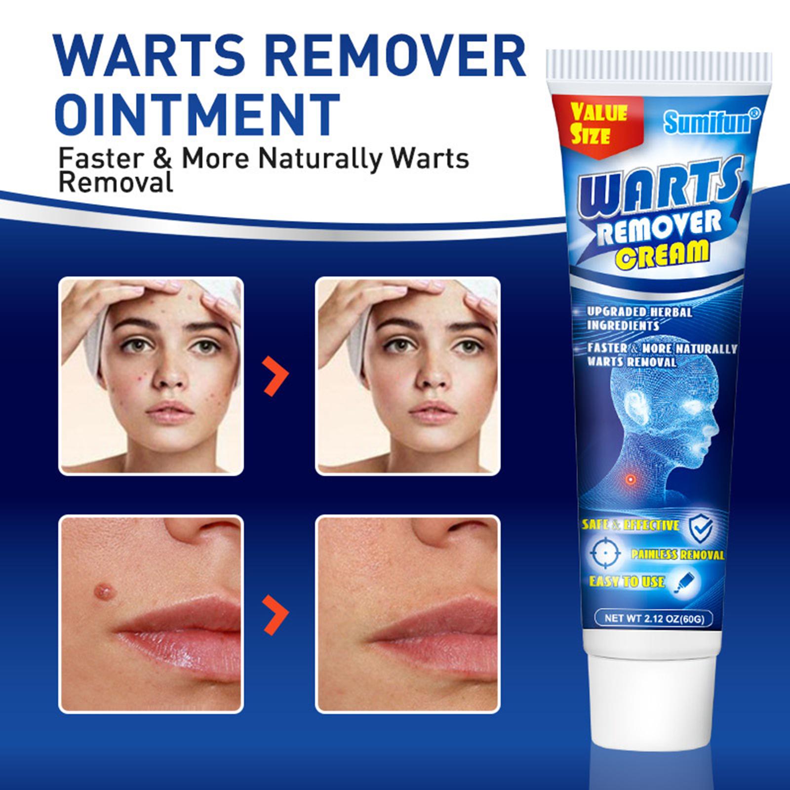 Wart soothing corns cream Ke wart cream