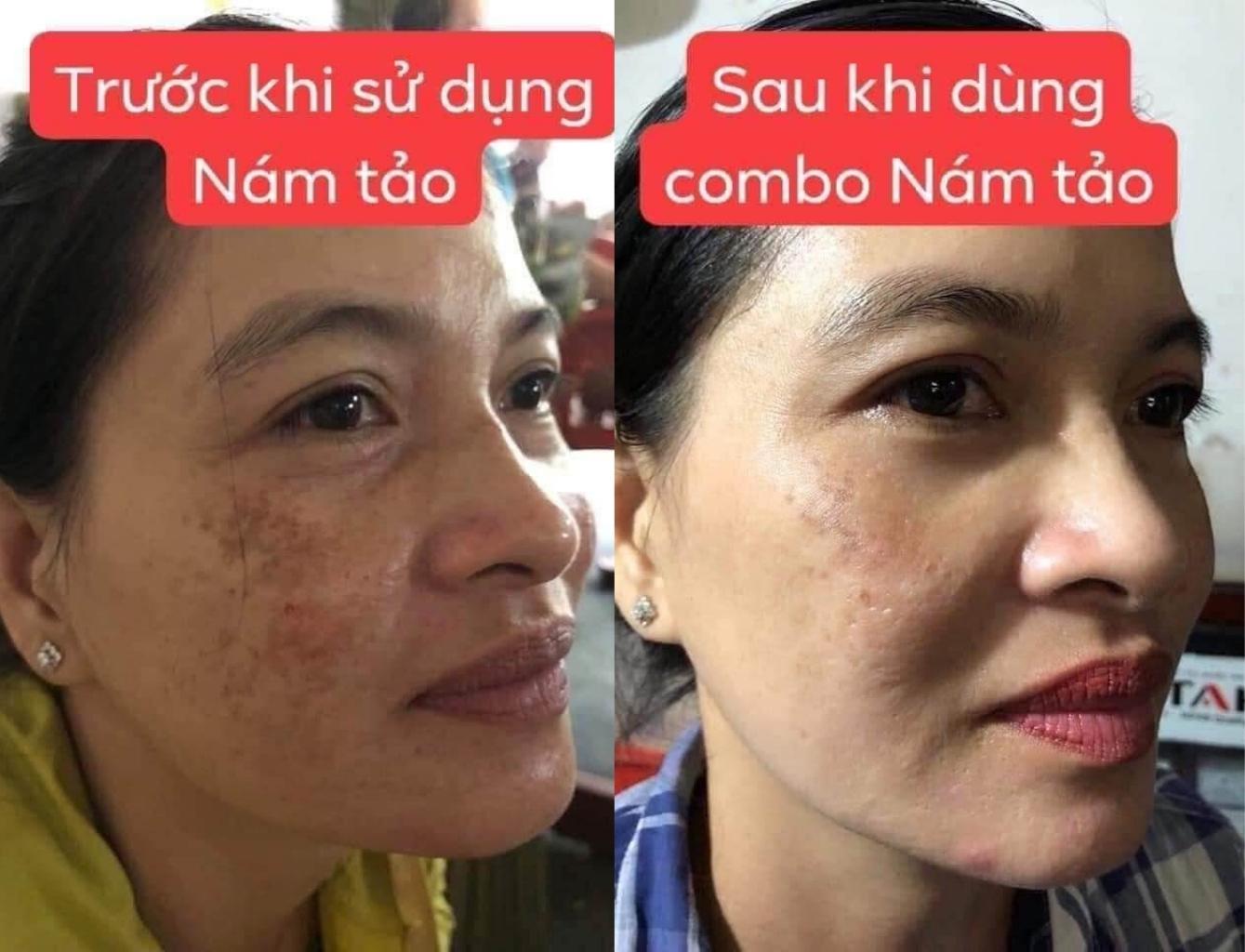 Combo gồm Kem + Serum Nám Tảo La'luxxy Dr Lacir Giúp Giảm Thâm Nám Tàn Nhang, Ức Chế Sản Sinh Melanin, Giảm Quá Trình Lão Hóa (Tặng Mặt Nạ Thủy Tinh) - KN Beauty Cosmetics