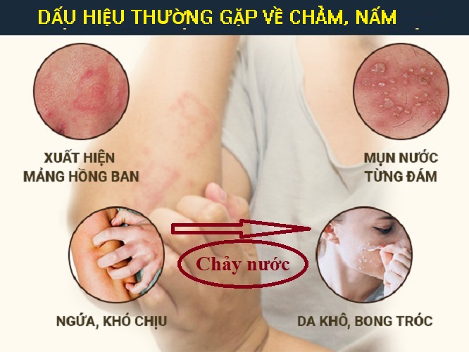 Kem bôi chàm da, tổ đỉa, mụn nước thành phần thảo dược thiên nhiên, an toàn và hiệu nghiệm tức thì_HBESTY