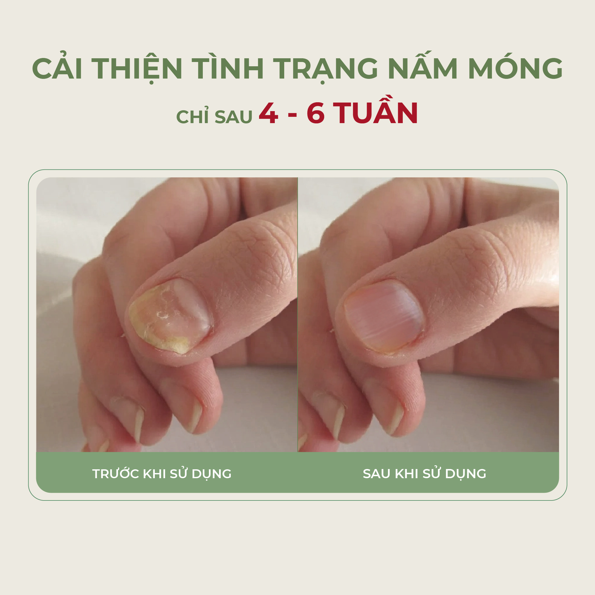 [Combo 2] Serum Nấm Móng ABERA - Đánh Bay Nấm Móng Với Nail Fungus ABERA - Sự Lựa Chọn Thông Minh Và An Toàn