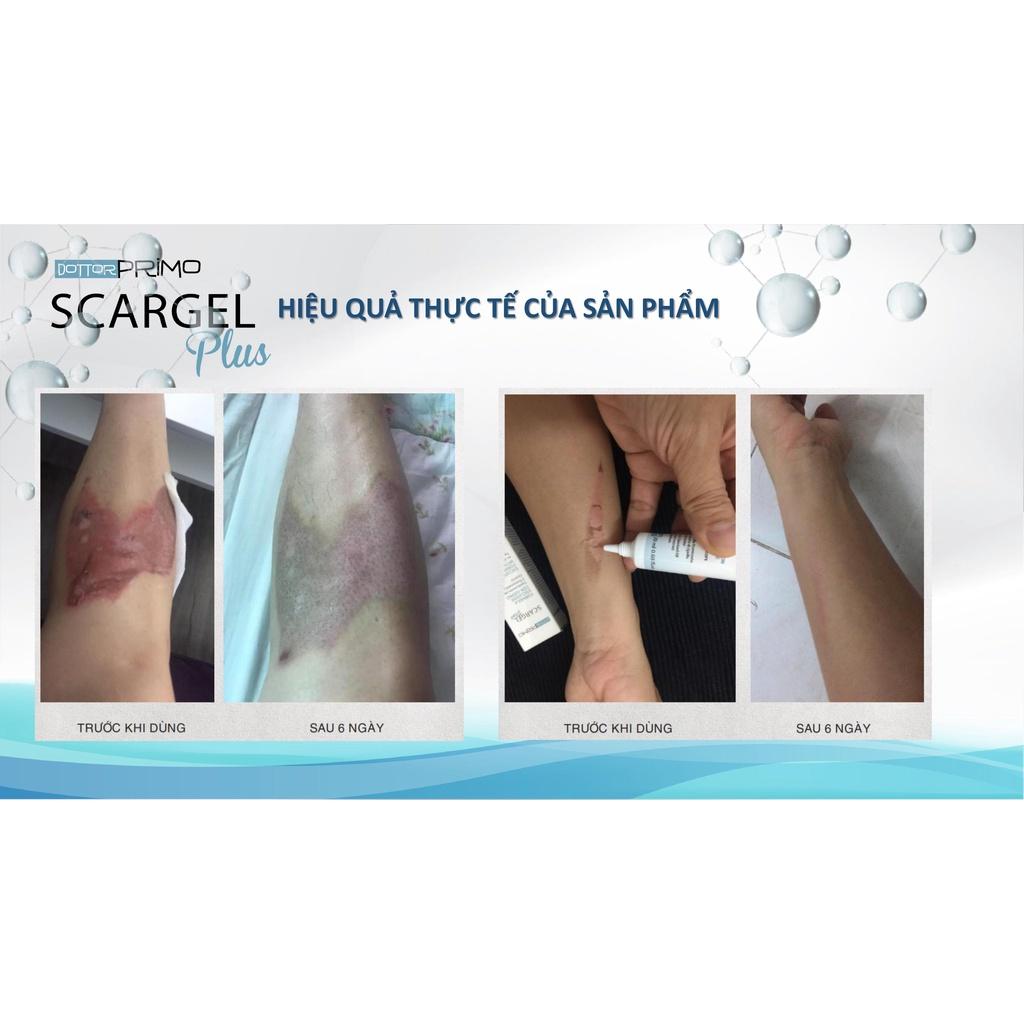 Kem Làm Mờ Sẹo DottorPrimo Scargel Plus Giúp Làm Mờ Sẹo Và Các Vết Thâm Do Sẹo