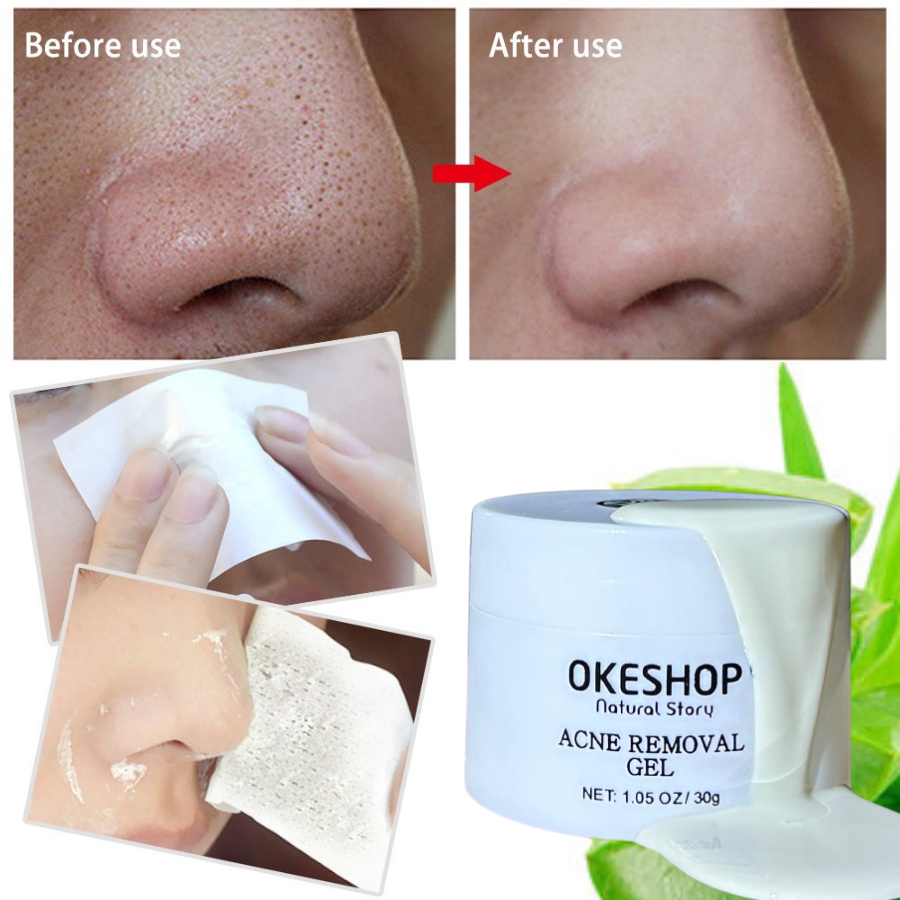 Gel Lột Mụn Nha Đam OKESHOP 30ml - Giải Pháp Loại Bỏ Mụn Đầu Đen - Mụn Cám - Bạ Nhờn - Làm Sạch Sâu Và Thu Nhỏ Lỗ Chân Lông