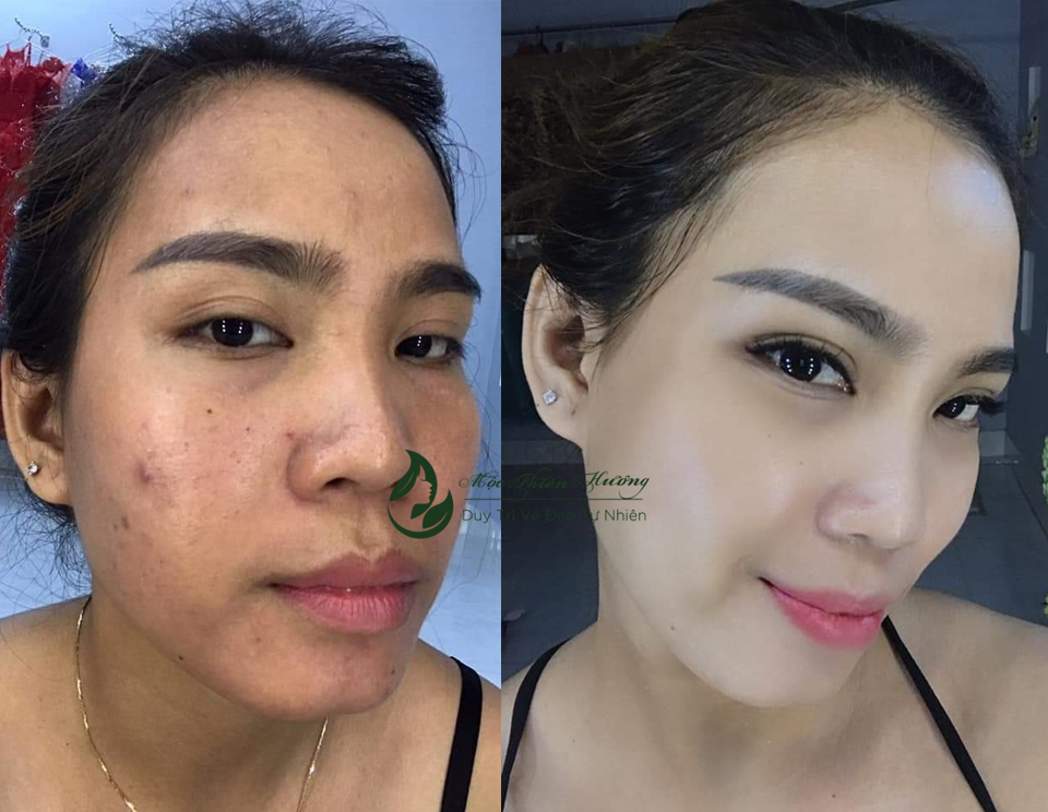 Serum 50ml Đánh Bay Mụn Thâm Nám Lâu Năm - Mộc Thiên Hương