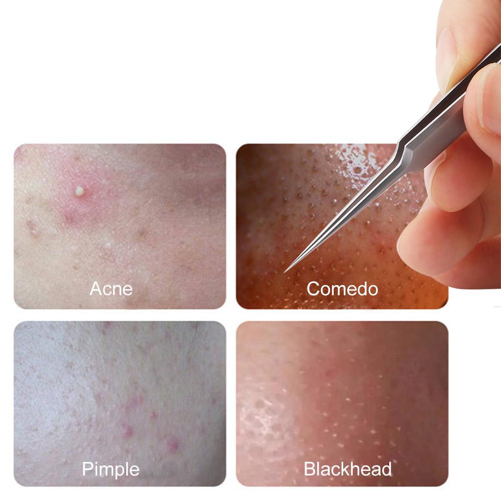 Bộ Dụng Cụ Chăm Sóc Da Nhíp Gắp Mụn Đầu Đen