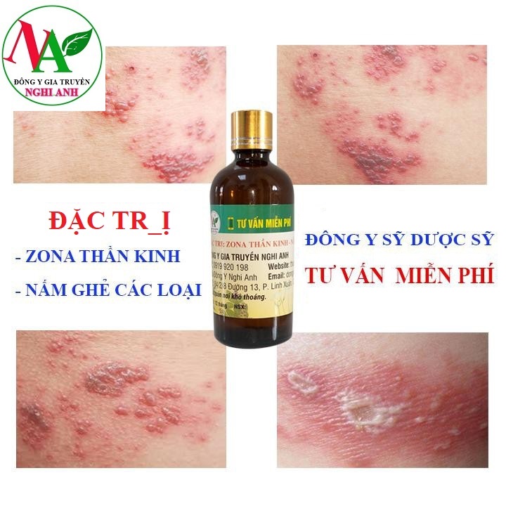 Thuốc Bôi Đặc Trị Zona Thần Kinh, Nấm Ghẻ, Ngứa Dị Ứng Hiệu Quả Đông Y Nghi Anh Lọ 100ml