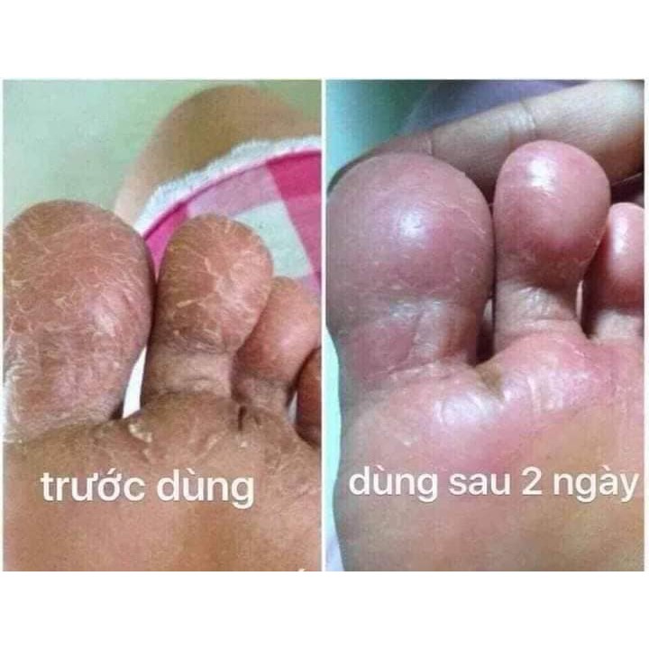Kem bôi hỗ trợ điều trị ngứa, vảy nến, á sừng, nứt chân 15 gram