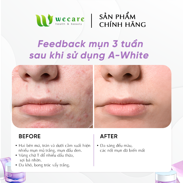 KEM GIẢM MỤN &amp; DƯỠNG TRẮNG DA &amp; DƯỠNG ẨM A-WHITE