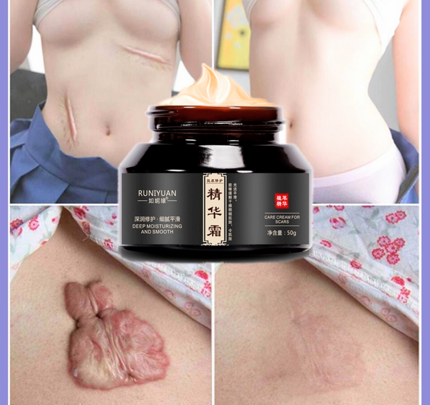 KEM TRỊ XÓA LÀM MỜ CÁC VẾT SẸO TRÊN DA HOÀN TOÀN NHANH CHÓNG HIỆU QUẢ CAO LOẠI TỐT NHẤT HIỆN NAY