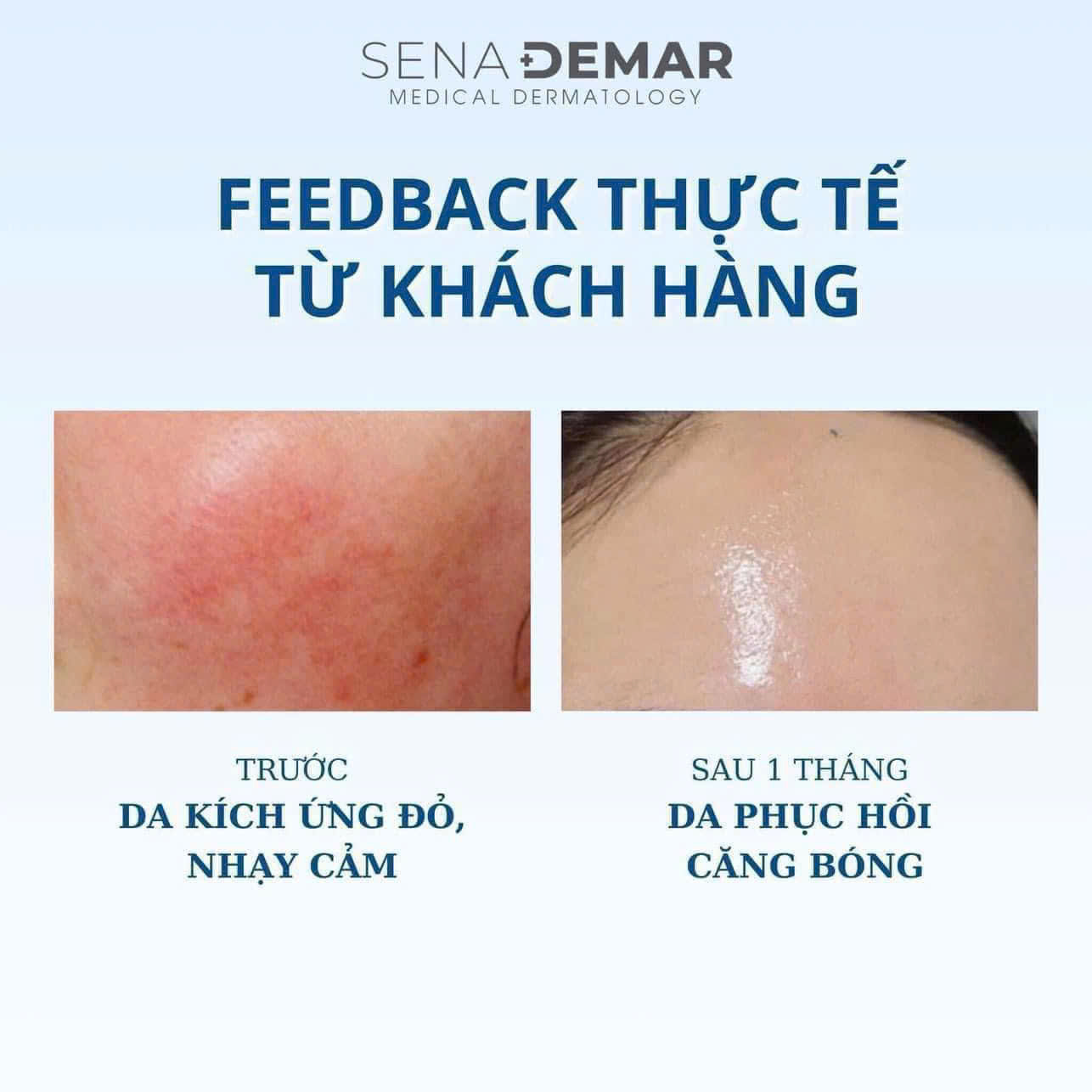 Serum B5 Senademar 100ml hạn 2027 microneedle ampoule Phục Hồi Da Cấp Ẩm Ngăn Ngừa Lão Hoá.
