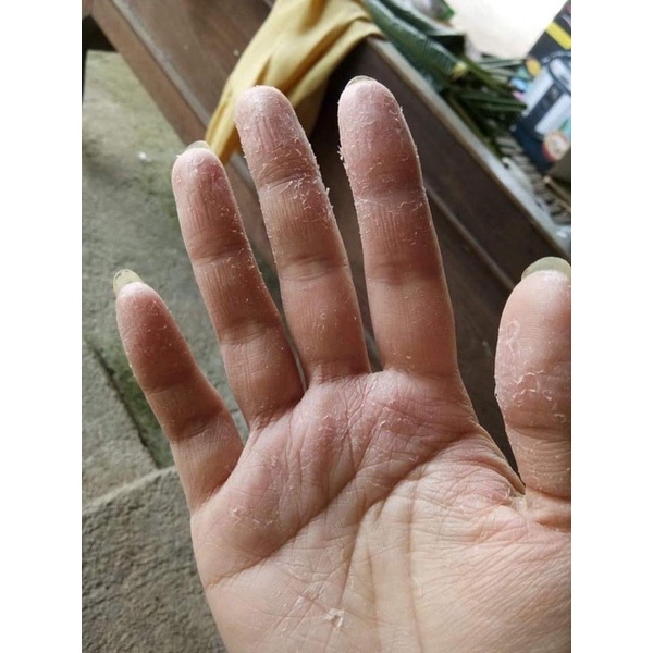 Thảo dược bôi nấm ngứa, tổ đỉa, hắc lào, lang ben, vảy nến, á sừng, zona các vấn đề về da_1 hộp 20 gói
