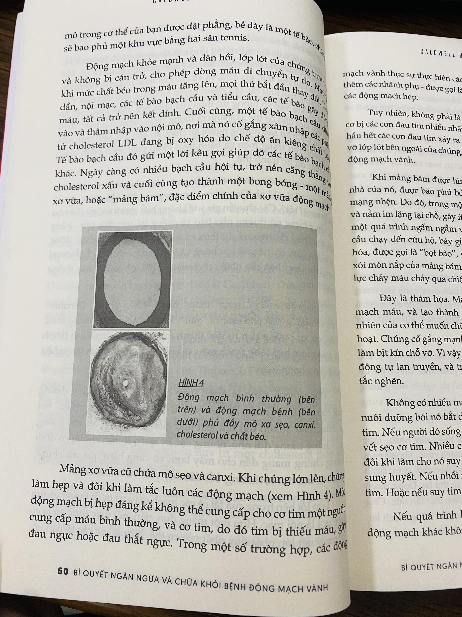 Bí Quyết Ngăn Ngừa Và Chữa Khỏi Bệnh Động Mạch Vành