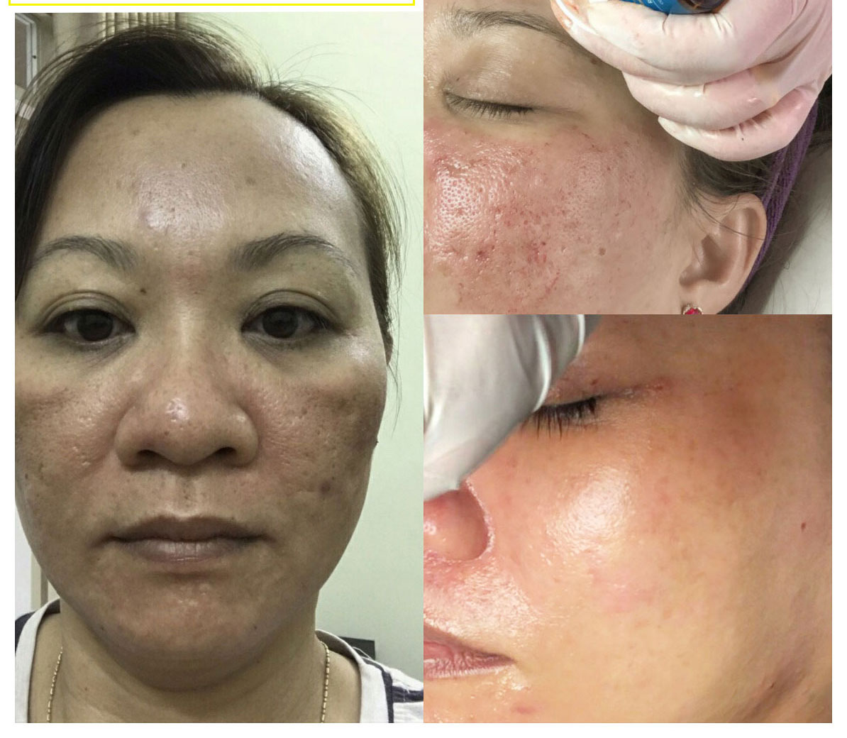 Tế bào gốc siêu tăng trưởng làm đầy sẹo lõm, căng bóng da Rejuvenating Ampoule