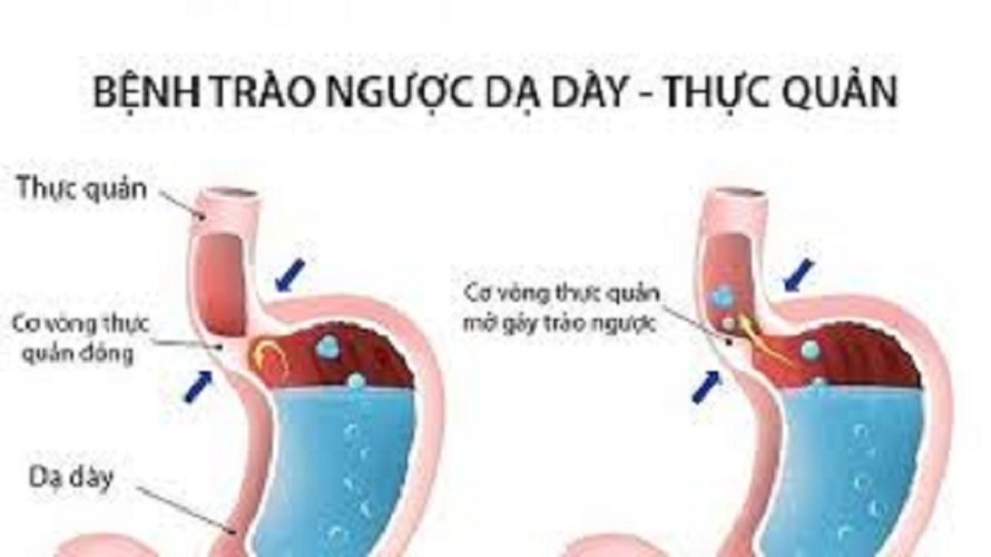 CHÈ DÂY RỪNG NGUYÊN CHẤT MẸ KEN