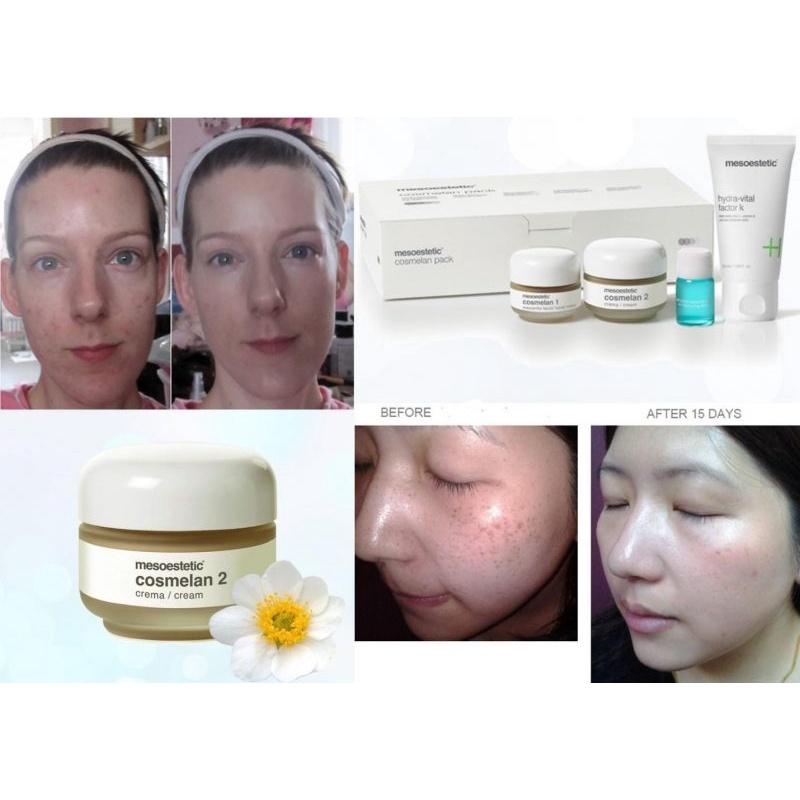 Kem giảm nám cao cấp Mesoestetic Cosmelan 2 30g bán chạy số 1 tại Tây Ban Nha