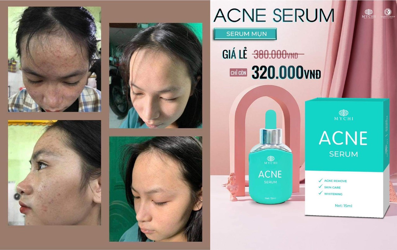 Serum mụn ACNE Mychi