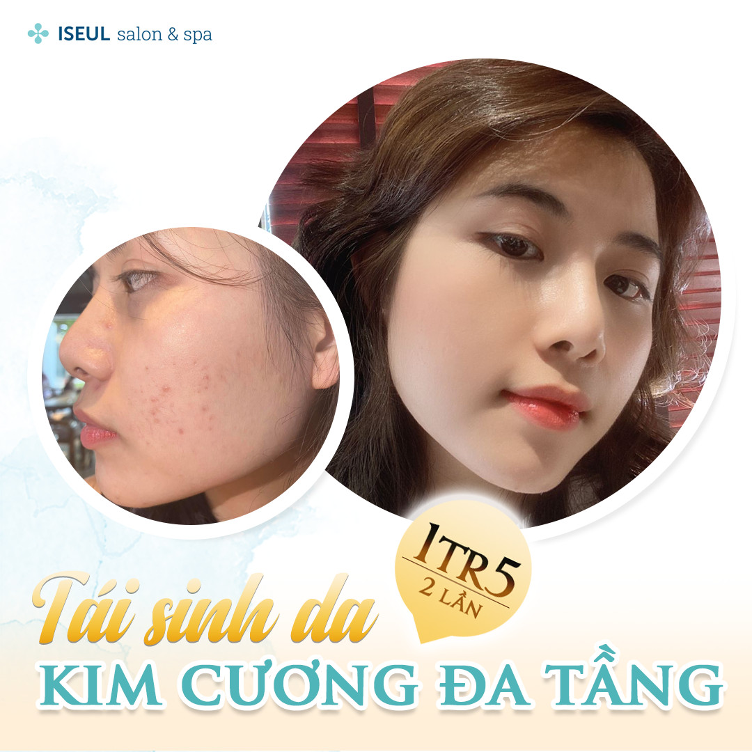 Iseul Spa - Voucher Tái Sinh Da Kim Cương Đa Tầng ( Combo 2 lần )