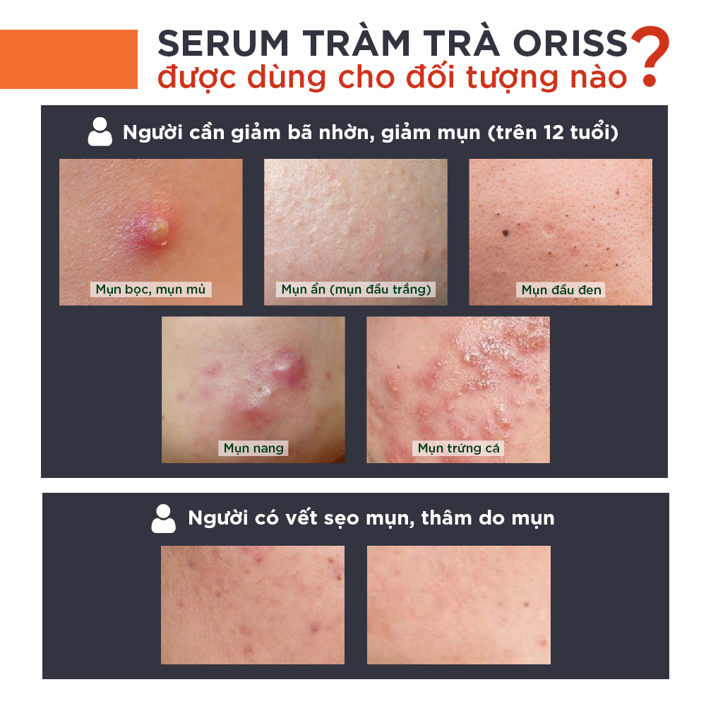 Serum Ngừa Mụn Dưỡng Trắng Da Oriss Cao Cấp