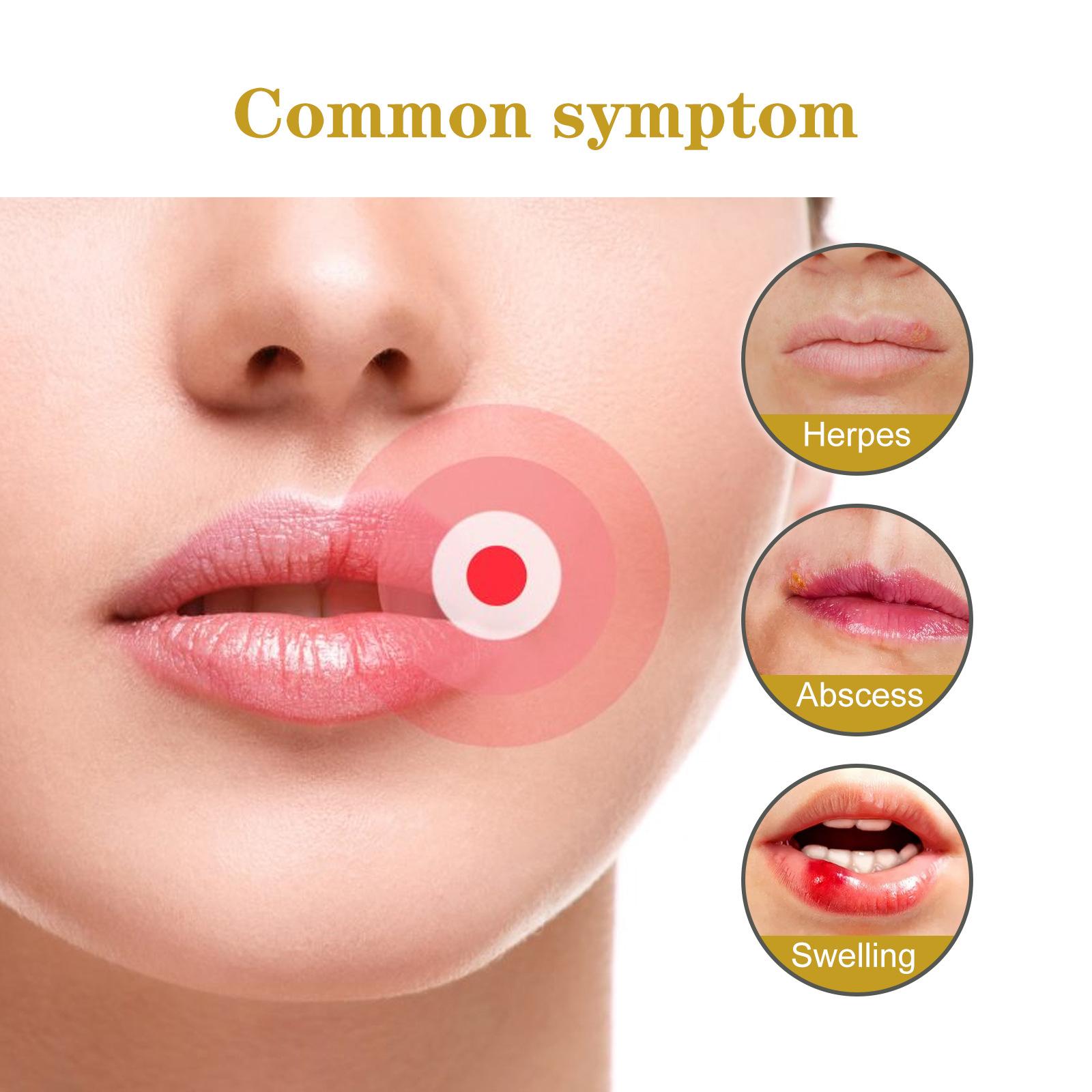 South Moon 60 patches Cold Sore Honey Patch Blister Treatment Conceals Protects Soothes & Hides Cold Sores