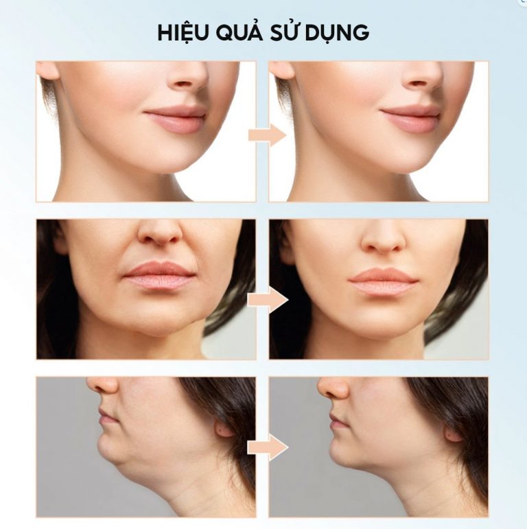 Máy Nâng Cơ Trẻ Hóa Da, Xóa Nhăn, Rảnh Cười, Nọng Cằm Giúp Da Săn Chắc Thon Gọn V-line tự nhiên JOOU 106A98 bằng Công nghệ EMS 15 cấp độ và 4 tia hồng ngoại TẶNG MÁY RỬA MẶT JOOU TRỊ GIÁ 599K