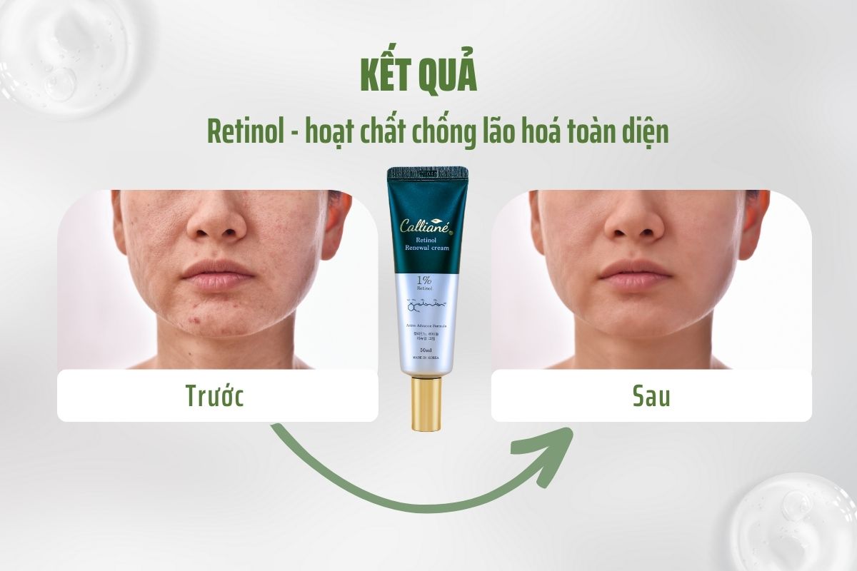 Kem Dưỡng Tái Tạo Chống Lão Hoá Da Retinol 1.0 Calliané Hàn Quốc