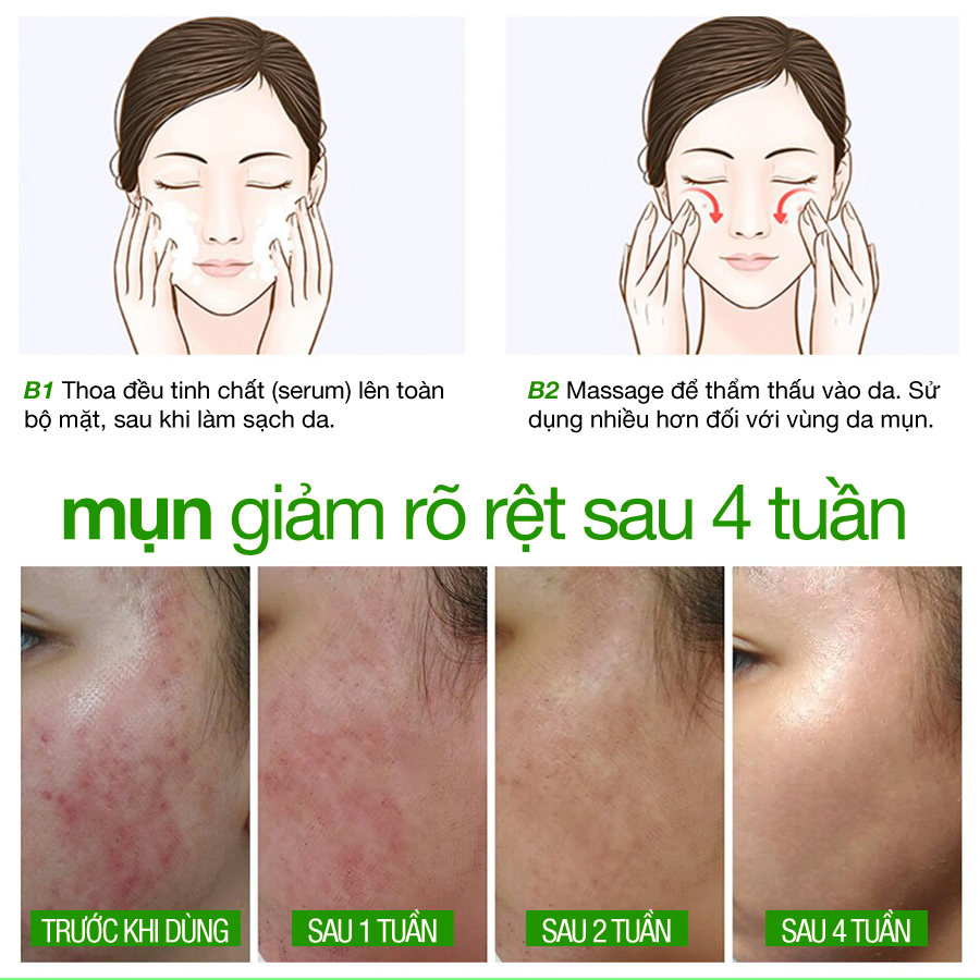 TINH CHẤT LÀM ĐẸP COLLAGEN+ TẠM BIỆT MỤN 10ml LANGCE