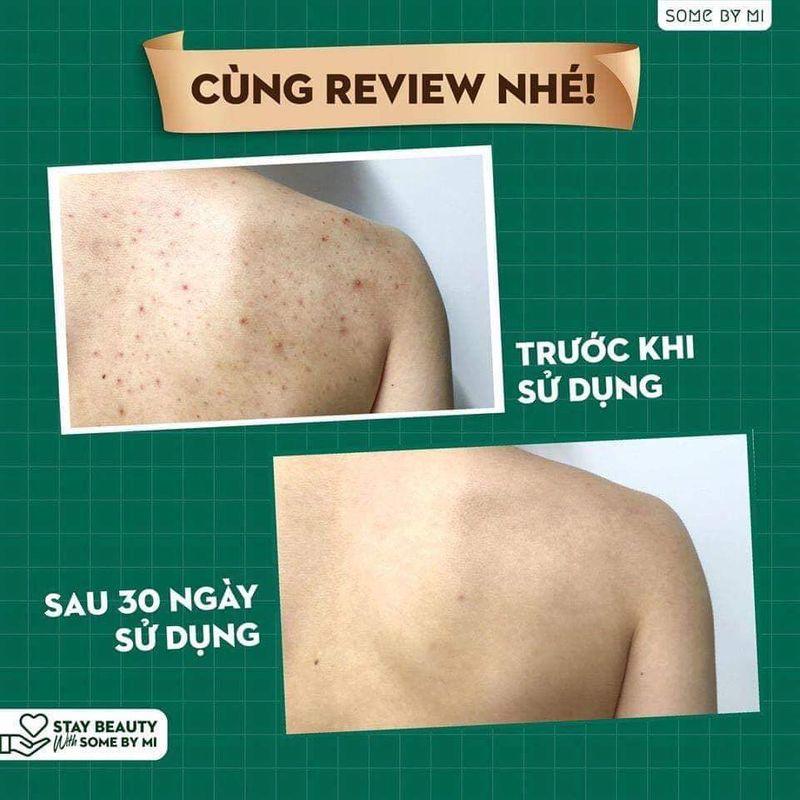 Combo Sữa Tắm Và Gel Dưỡng Ẩm Dành Cho Da Mụn Some By Mi AHA-BHA-PHA (Body Cleanser 400ml + Soothing Gel 300ml) + Tặng Kèm 1 Băng Đô Tai Mèo (Màu Ngẫu Nhiên)