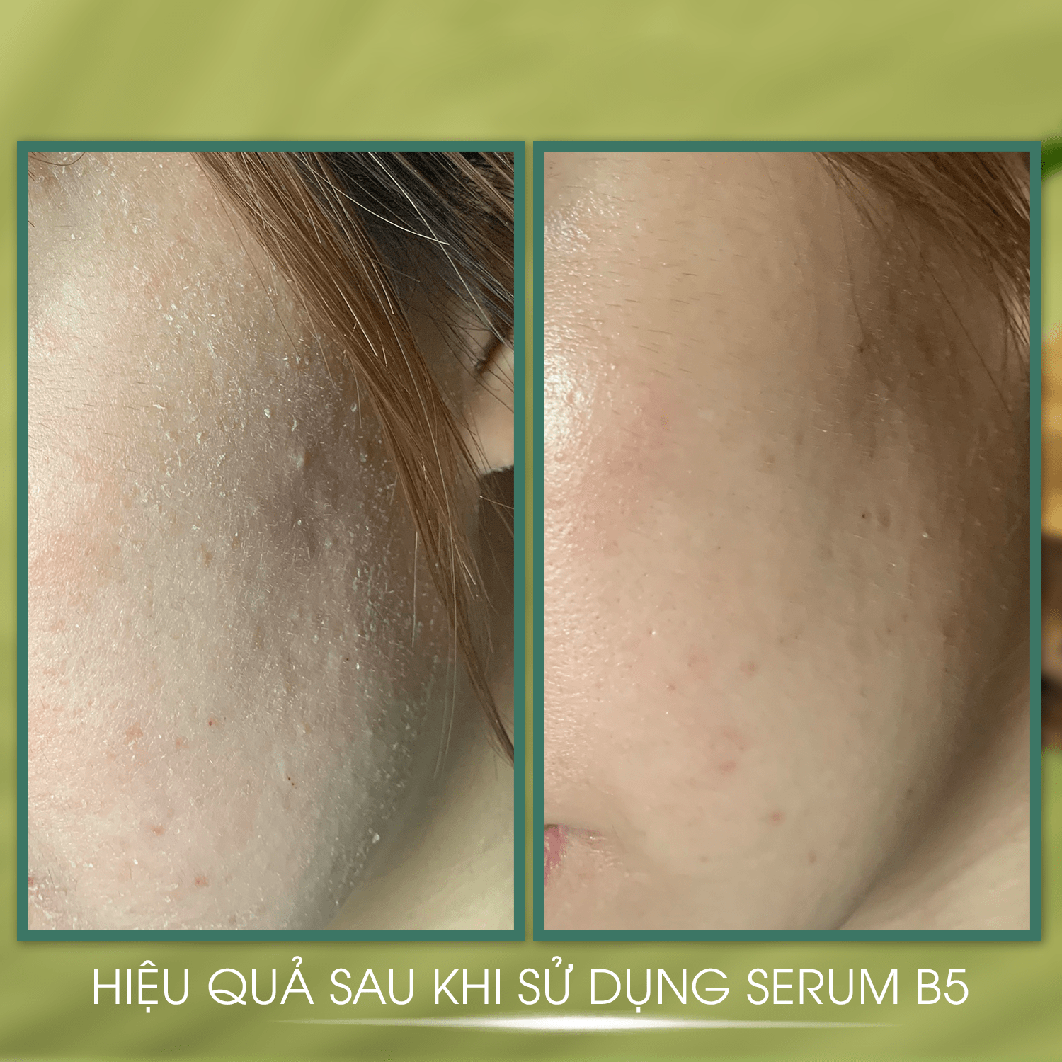 Serum Phục Hồi Da Hyaluronic Acid + Vitamin B5 - JOA GREEN 30ml, Serum B5 Tái Tạo Da Và Chống Lão Hoá - Mỹ Phẩm MS COSMETIC