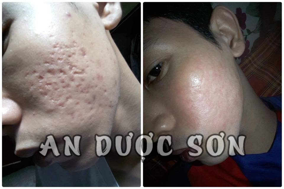 Combo Serum ngừa mụn thâm sẹo rỗ An Dược Sơn 30ml + Bột rửa mặt an dược sơn