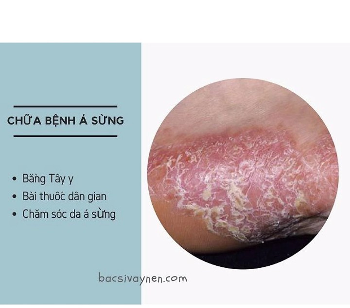 KEM BÔI DA LIỄU ĐÔNG Y-Nấm ngứa, tổ đỉa, hắc lào, lang men, vẩy nến, á sừng, zona các vấn đề về da