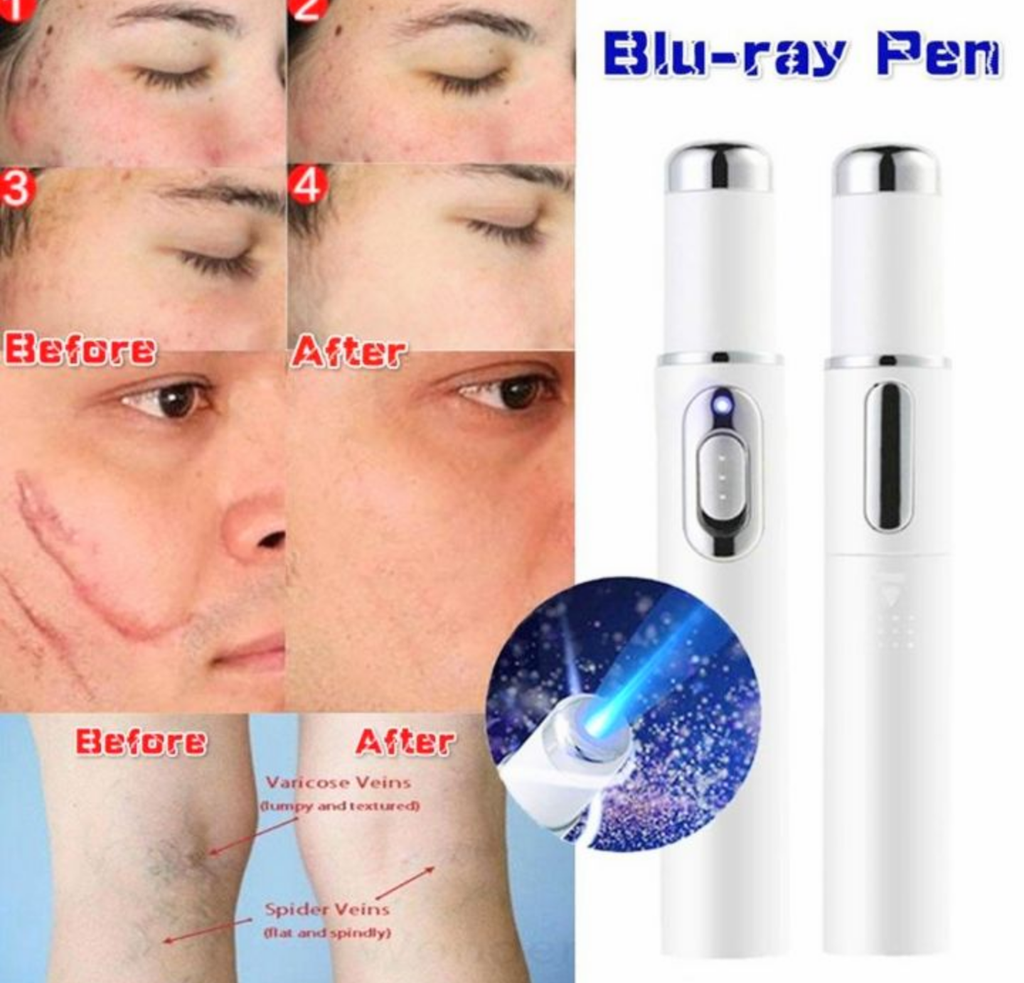 1 BÚT MÁY ÁNH SÁNG XANH XÓA TRỊ MỤN SẸO TRÊN DA HIỆU QUẢ AN TOÀN TIỆN DỤNG HÀNG CHẤT LƯỢNG