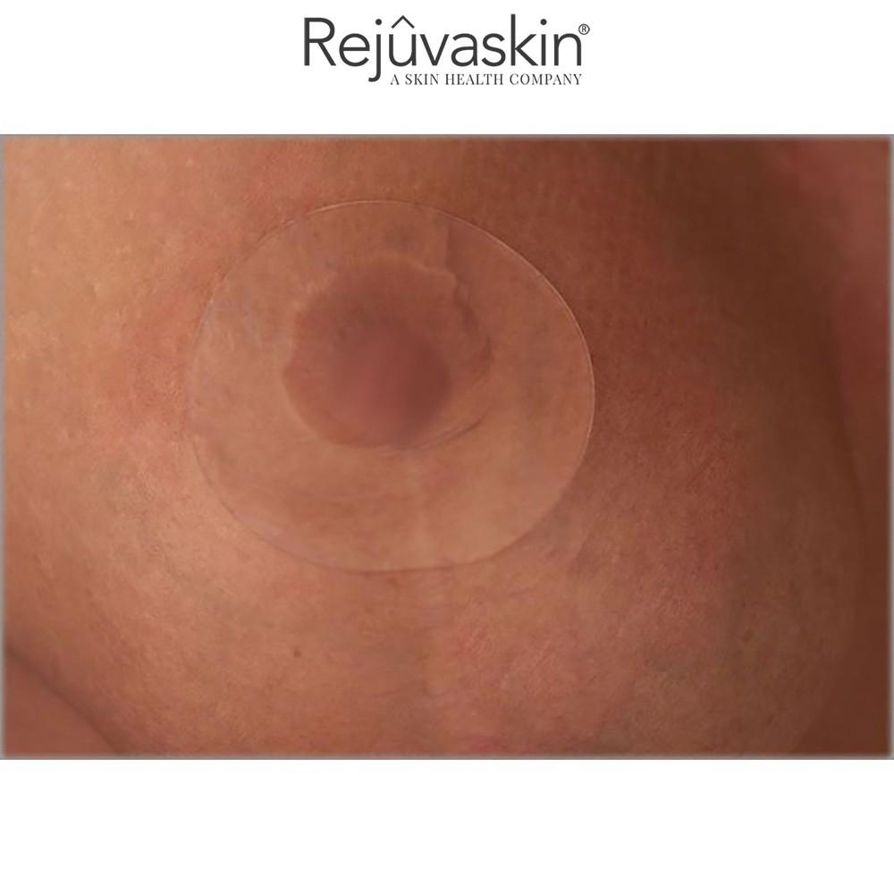 Miếng dán xóa mờ sẹo phẫu thuật ngực REJUVASKIN Scar FX 3″ Breast Circle