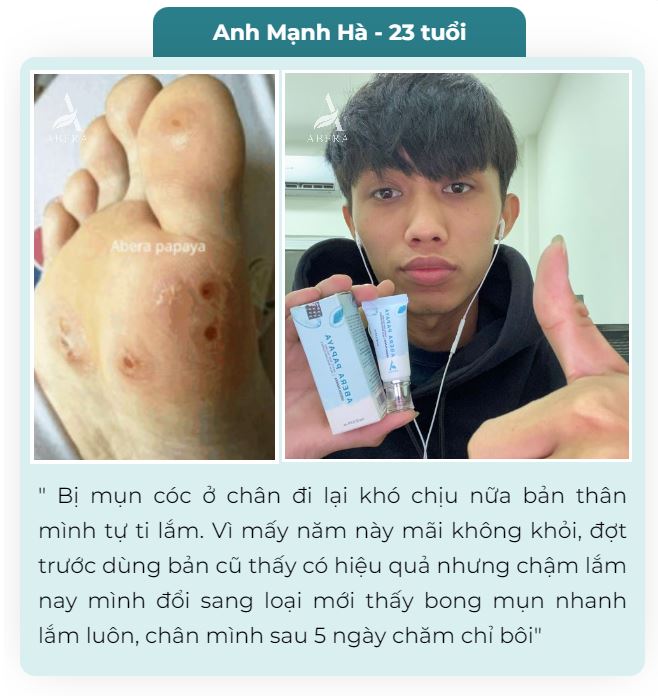 Tinh Chất Đu Đủ Xanh Abera Papaya 7ml - Tinh chất xử lý Mụn Cóc, Mụn Cơm,...