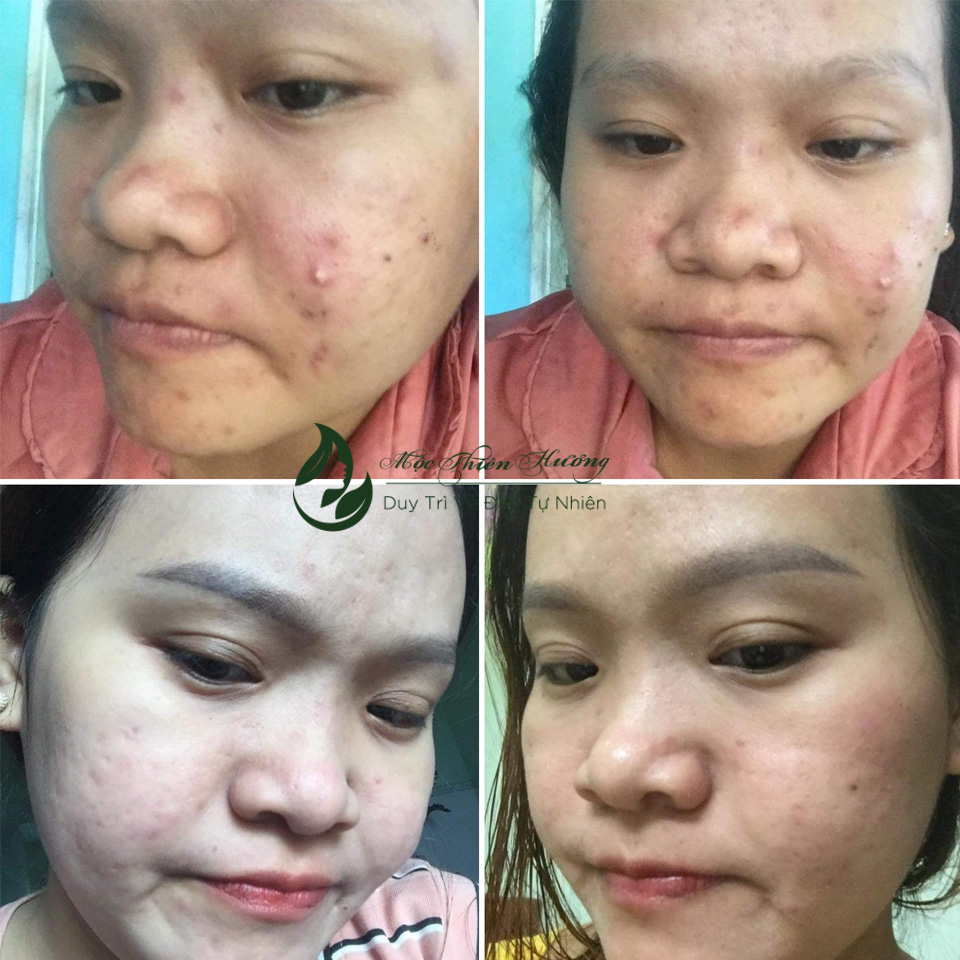 Serum 50ml Đánh Bay Mụn Thâm Nám Lâu Năm - Mộc Thiên Hương