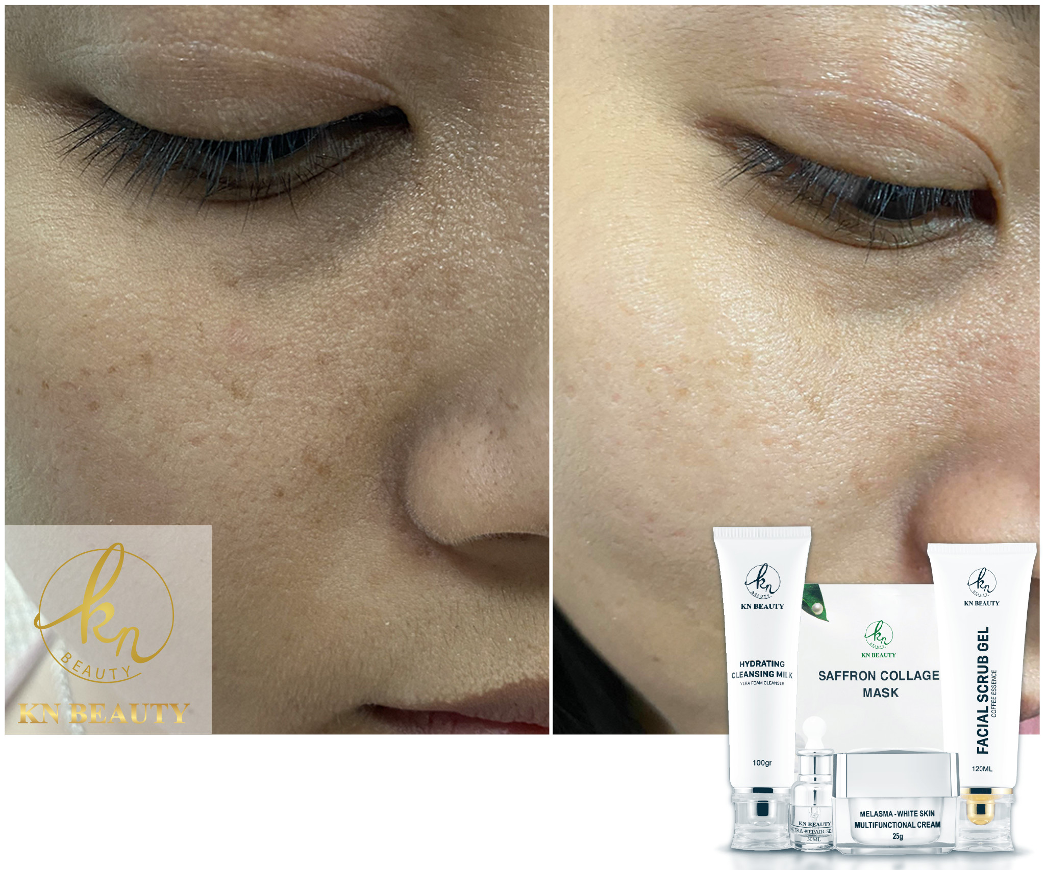 Bộ 4sp Trắng Da Ngừa Nám KN Beauty chuyên sâu:Kem dưỡng+Serum+Sữa rửa mặt+Tẩy tế bào chết