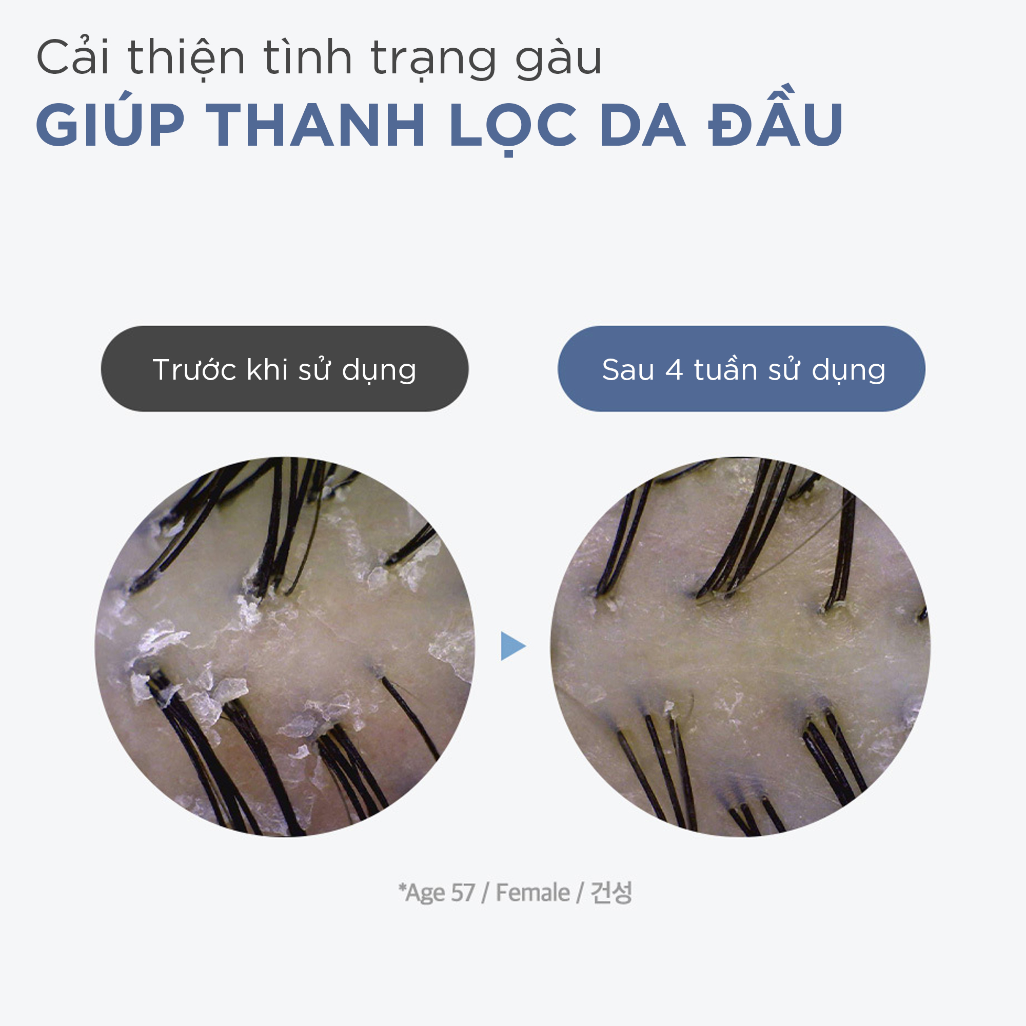 Bộ dầu gội giảm gàu giảm ngứa và xịt dưỡng hỗ trợ mọc tóc dày và khỏe Dr.FORHAIR Folligen Anti-Dandruff Shampoo và Folligen Tonic Original