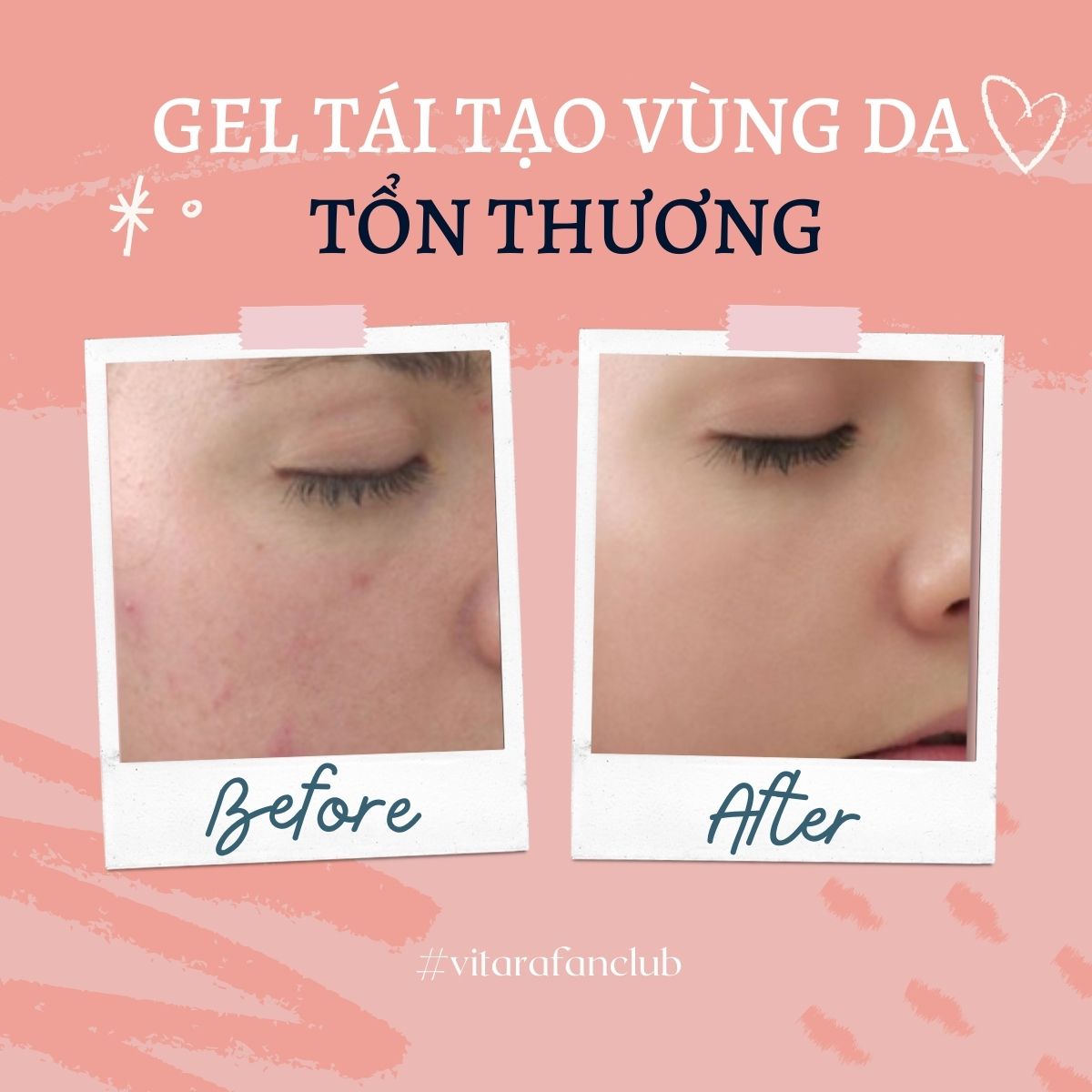 Gel thoa bỏng Burnova Plus tái tạo da sau bỏng, sau laser, làm lành vết thương, vết thương mụn 25g