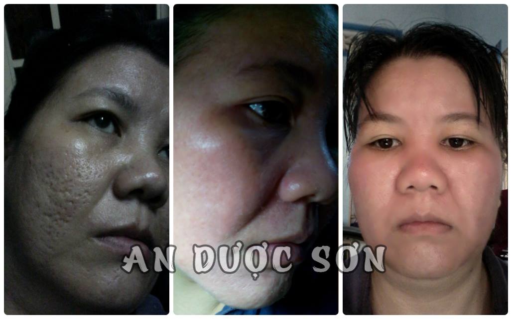 Serum ngừa mụn thâm sẹo rỗ An Dược Sơn 50ml & Bột rửa mặt an dược sơn
